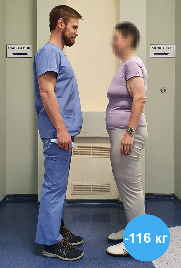Гастрошунтирование - Фото пациента после операции